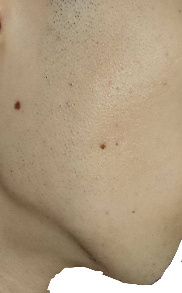 右もみあげ脱毛３回目２４時間後