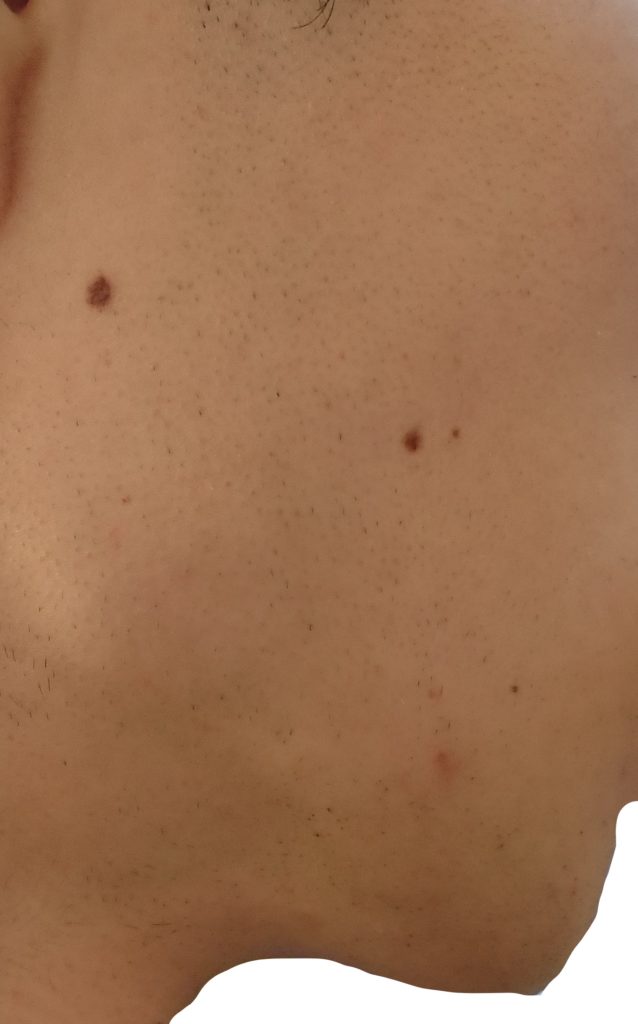 右もみあげ脱毛４回目直前２４時間後