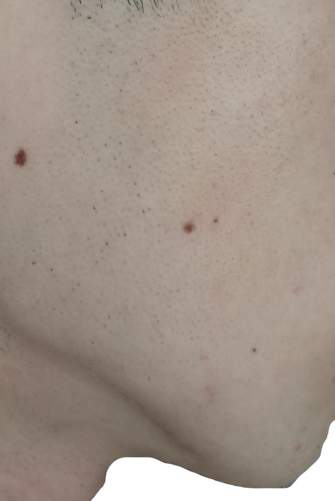 右もみあげ脱毛４回目２４時間後