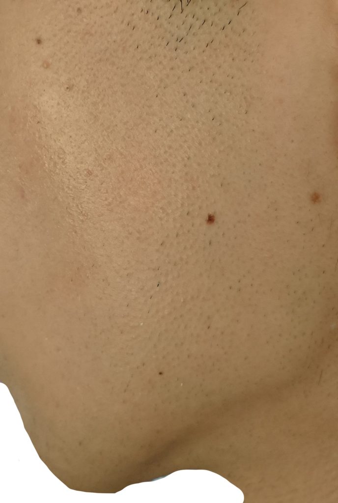 左もみあげ脱毛４回目直前２４時間後