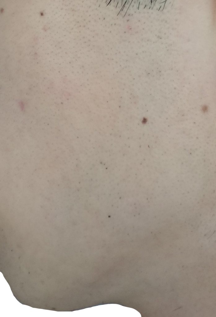 左もみあげ脱毛４回目２４時間後