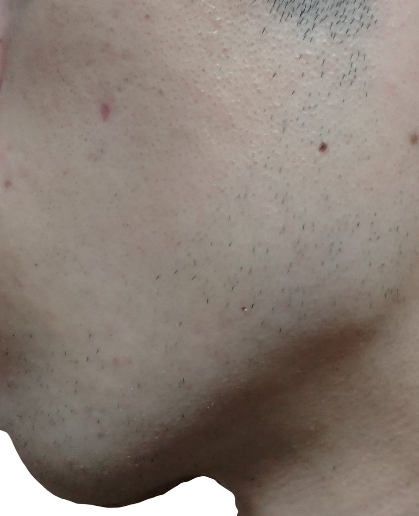 左もみあげ脱毛3回目直前24時間後