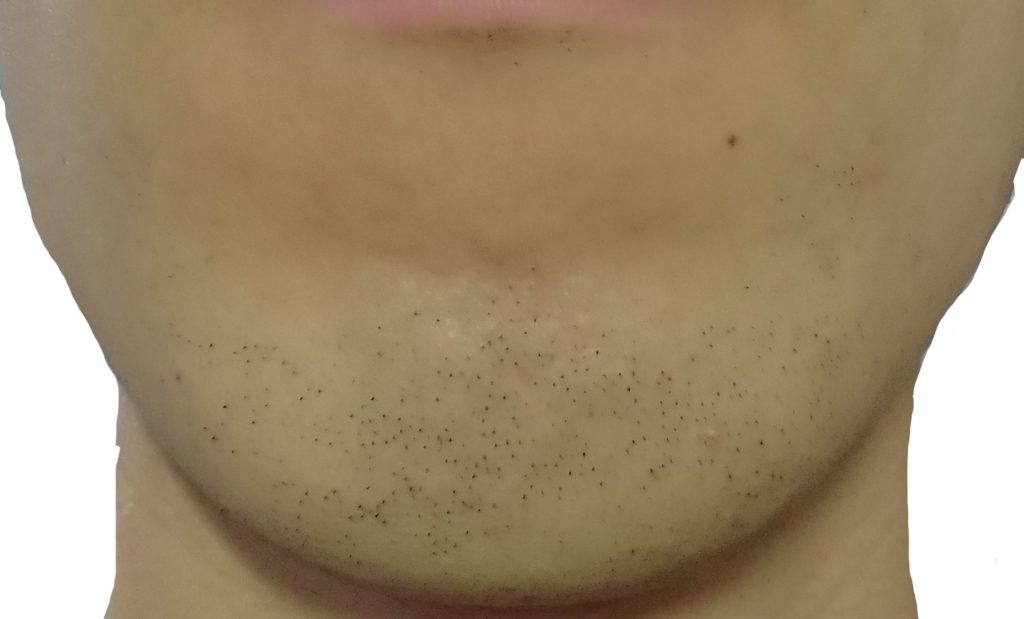 顎脱毛３回目２４時間後