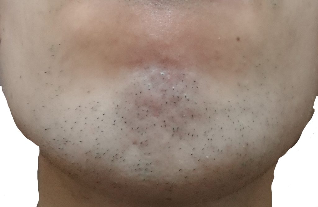 顎脱毛3回目直前24時間後