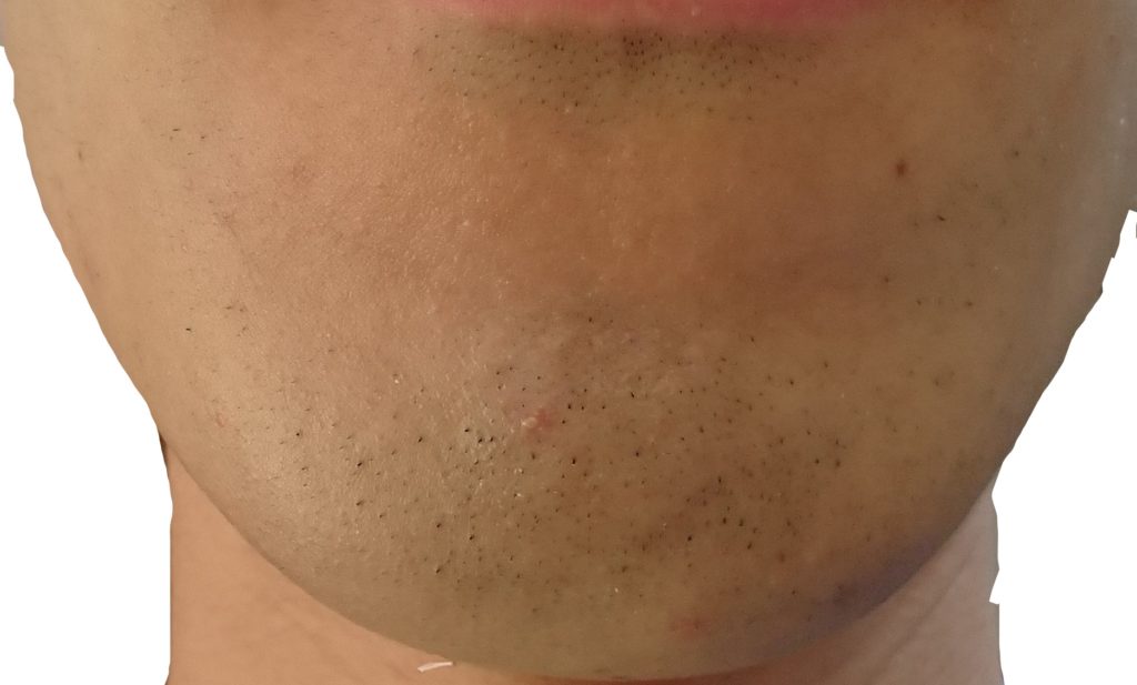 顎脱毛４回目直前２４時間後