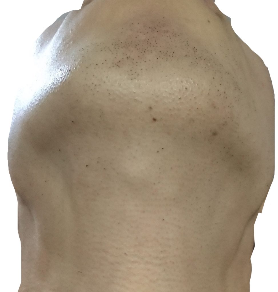 顎下脱毛３回目２４時間後