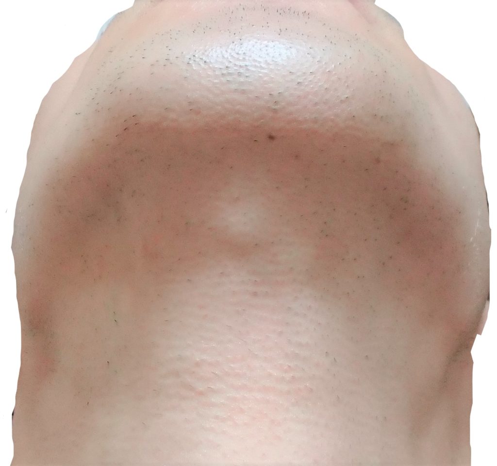 顎下脱毛3回目直前24時間後