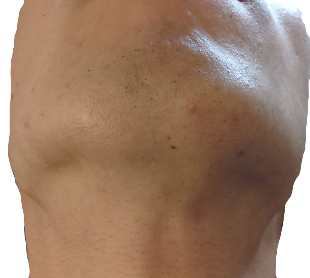 顎下脱毛４回目直前２４時間後