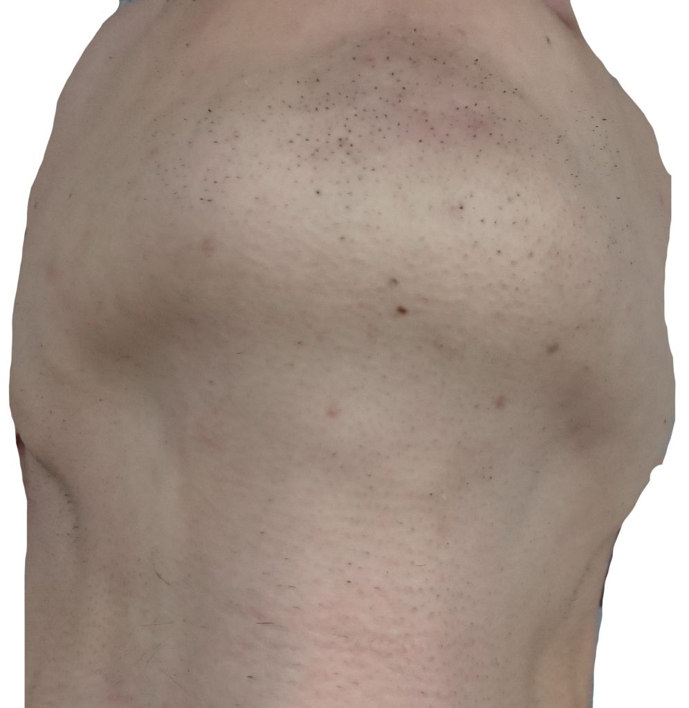 顎下脱毛４回目２４時間後