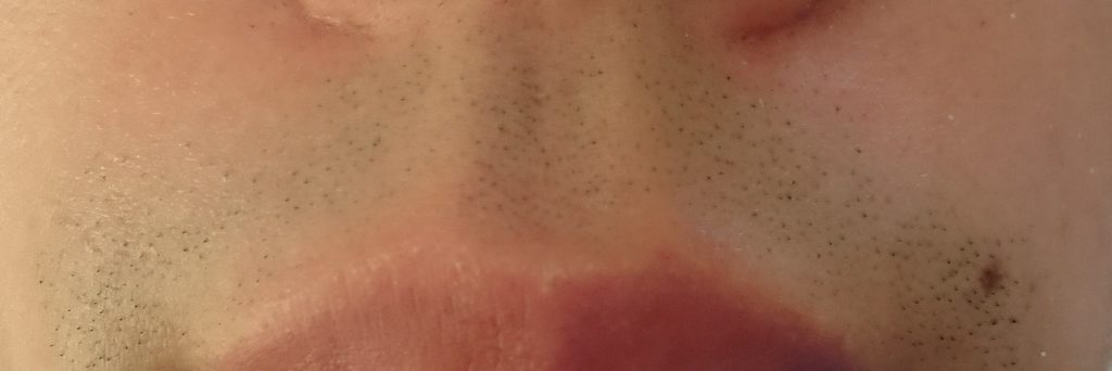 鼻下脱毛４回目直前２４時間後