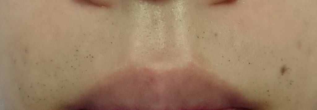 鼻下脱毛３回目２４時間後