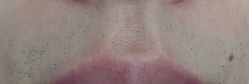 鼻下脱毛４回目２４時間後