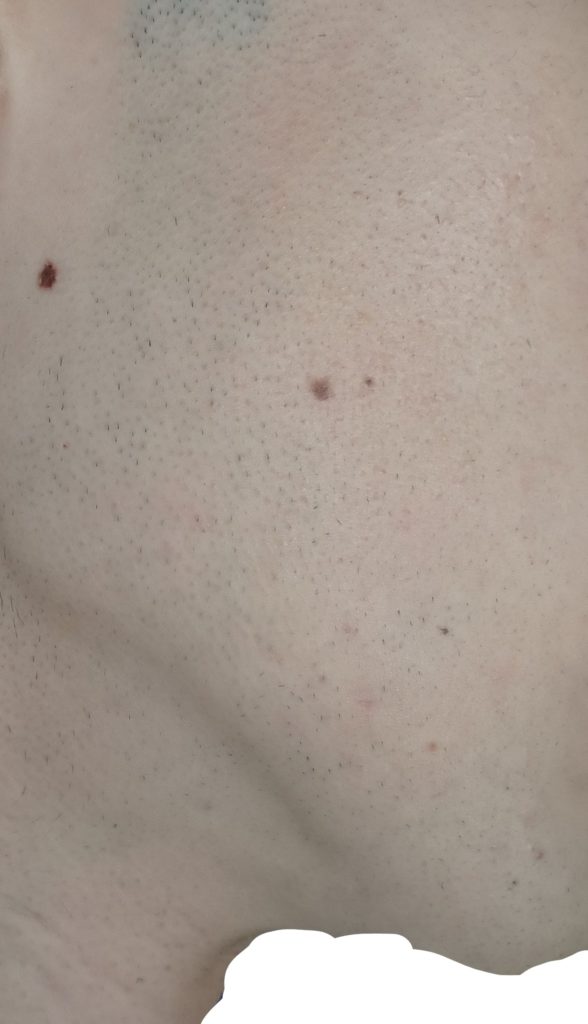 右もみあげ脱毛５回目直前２４時間後