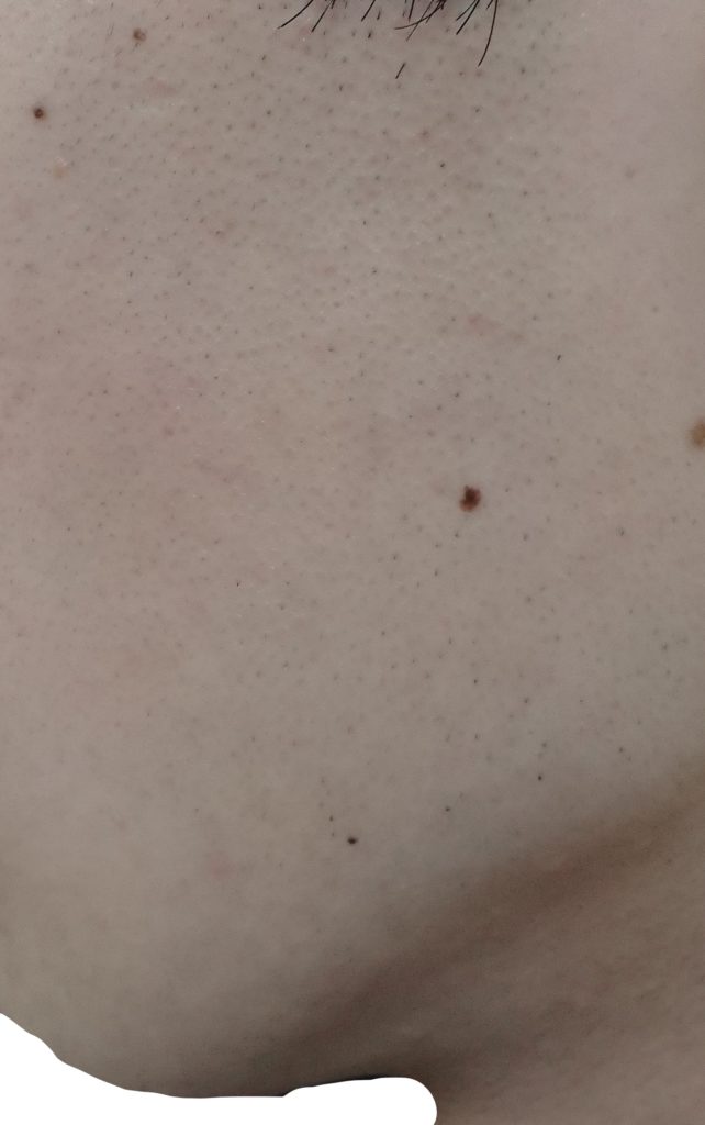 左もみあげ脱毛５回目２４時間後