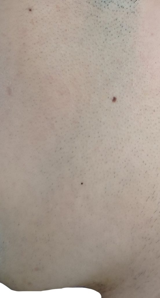 左もみあげ脱毛５回目直前２４時間後