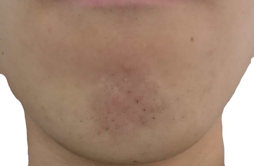 顎脱毛５回目２４時間後