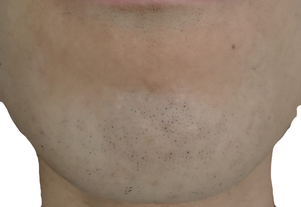 顎脱毛５回目直前２４時間後