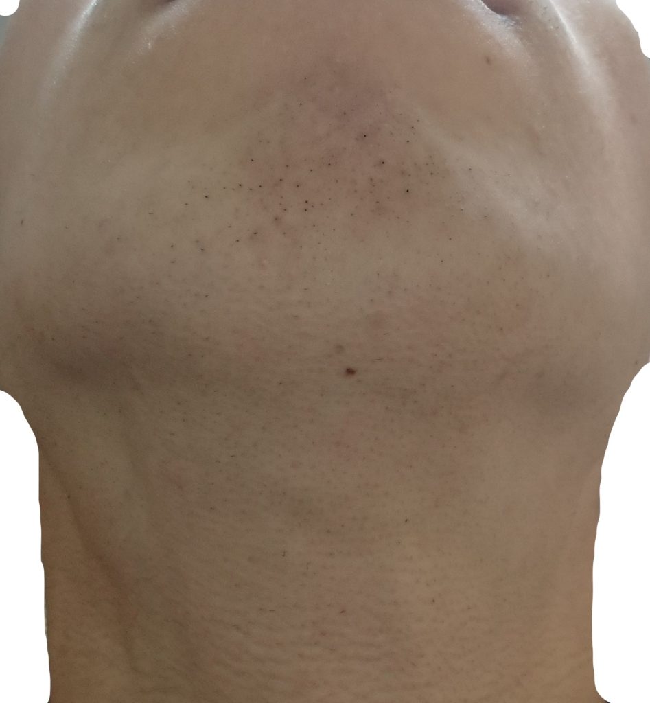 顎下脱毛５回目２４時間後