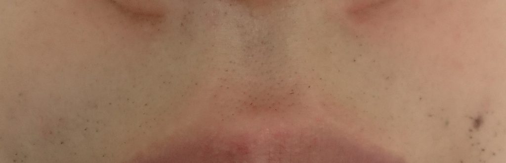 鼻下脱毛５回目２４時間後