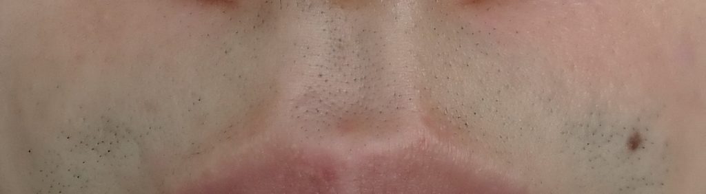 鼻下脱毛５回目直前２４時間後