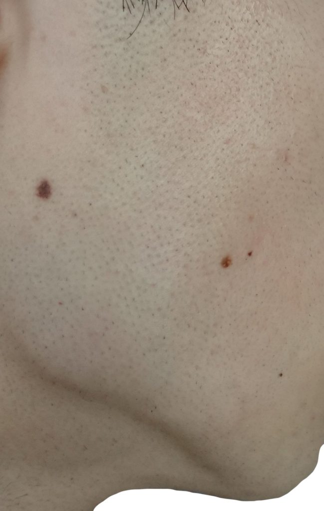 右もみあげ脱毛６回目２４時間後