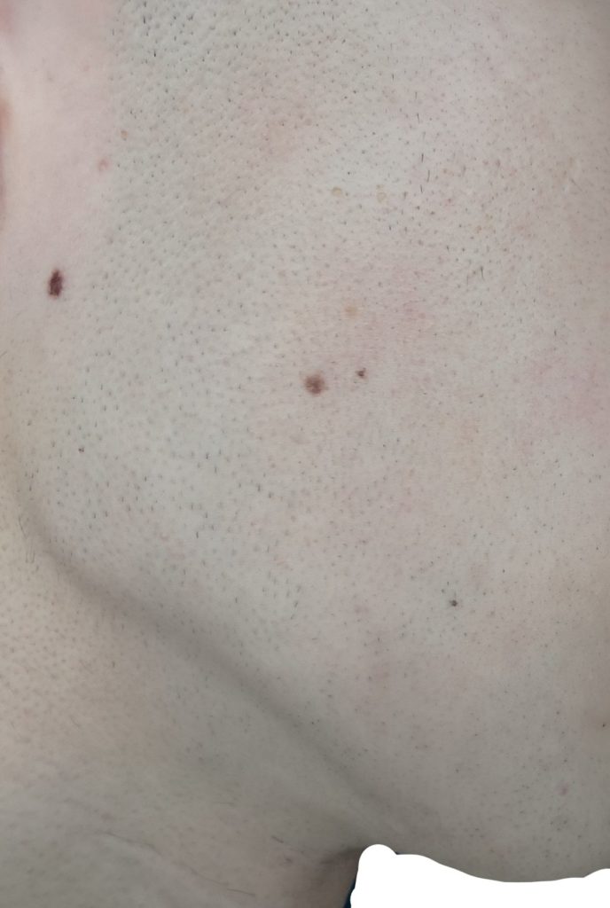 右もみあげ脱毛６回目直前２４時間後