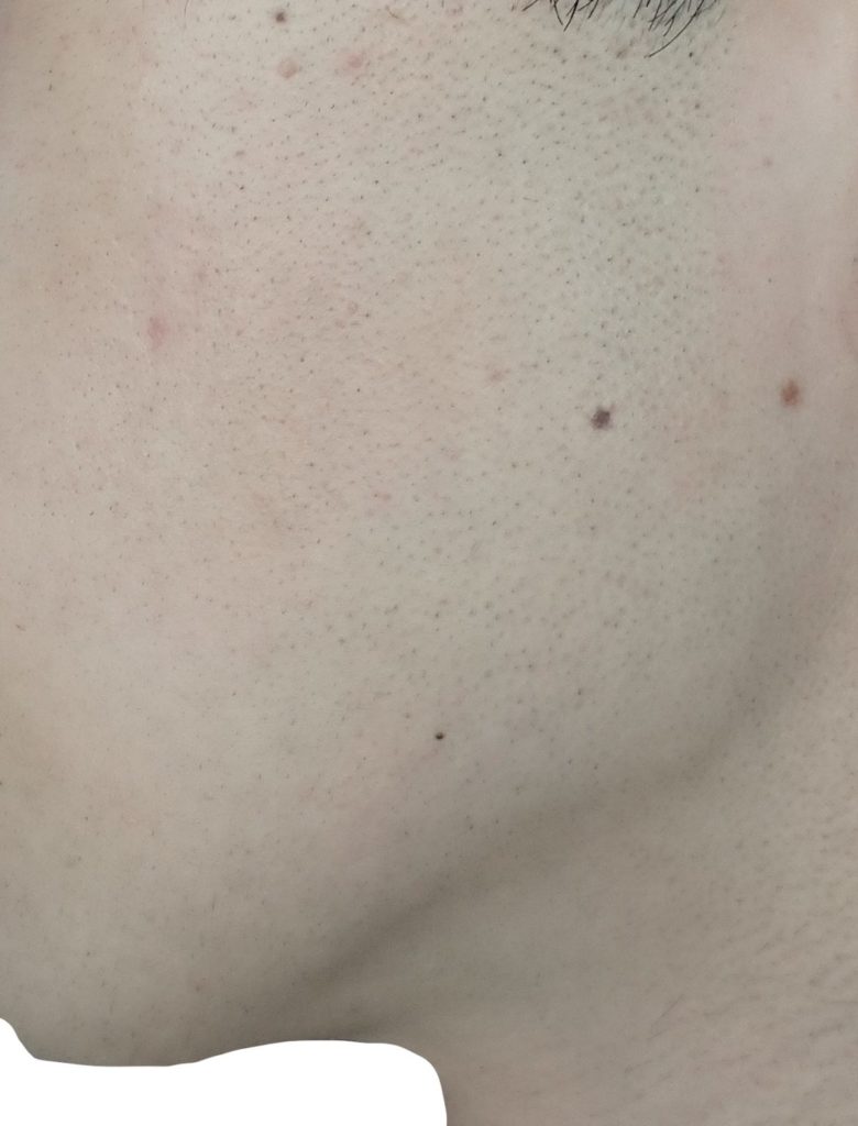 左もみあげ脱毛６回目２４時間後