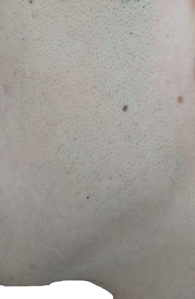 左もみあげ脱毛６回目直前２４時間後