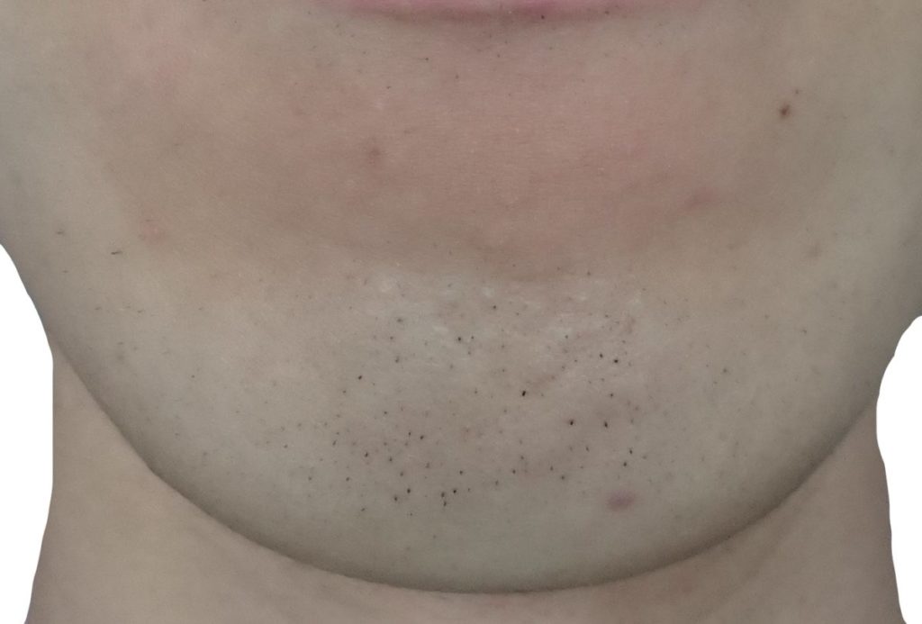 顎脱毛６回目２４時間後