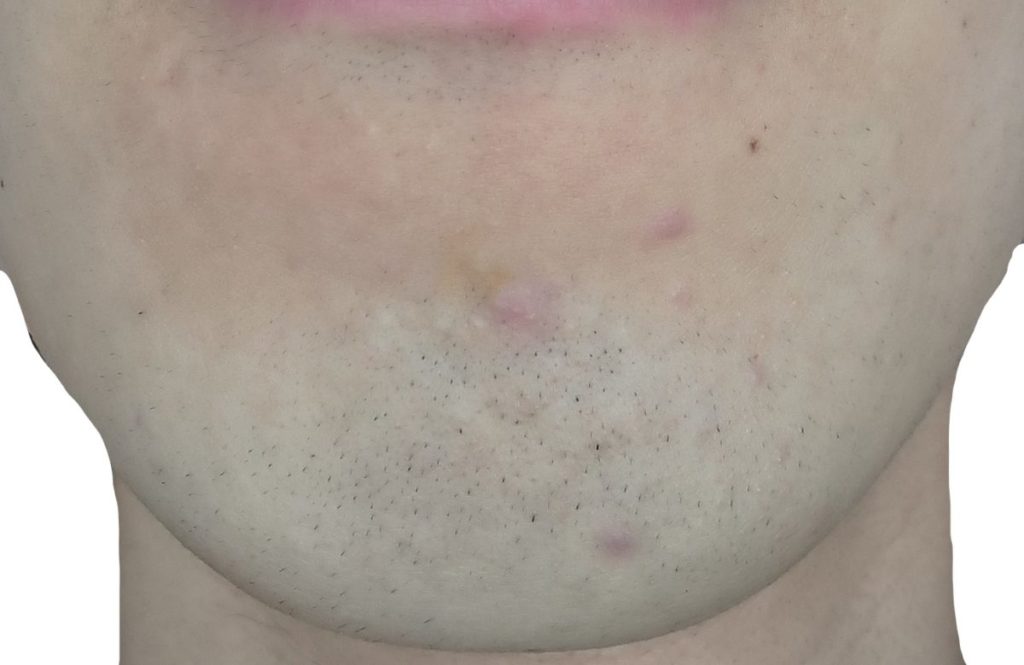 顎脱毛６回目直前２４時間後