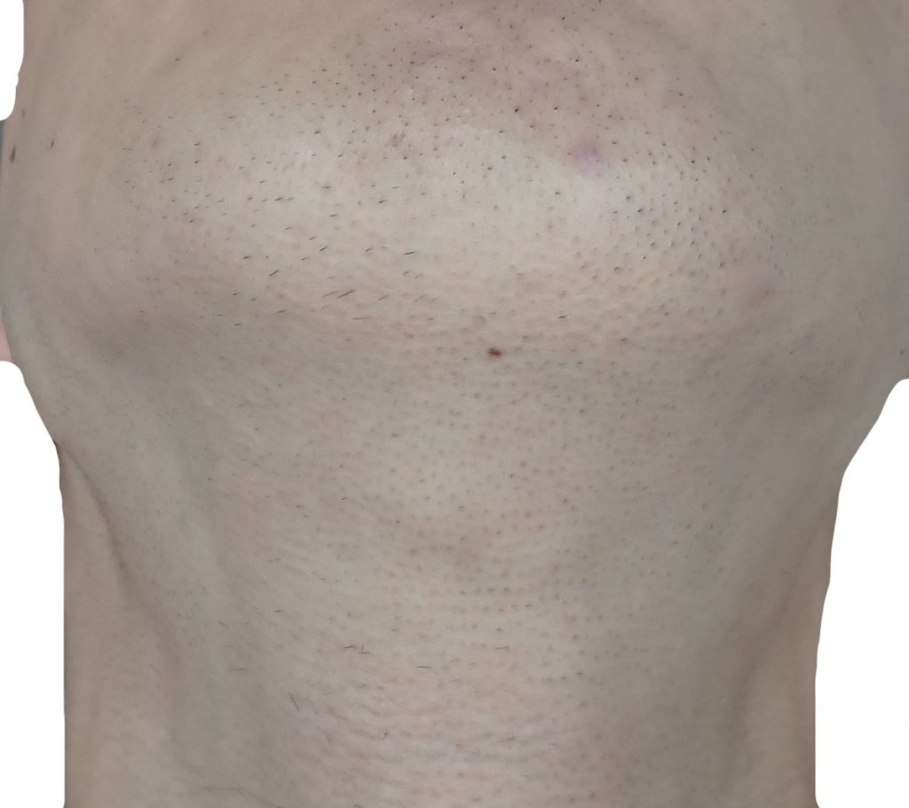 顎下脱毛６回目直前２４時間後