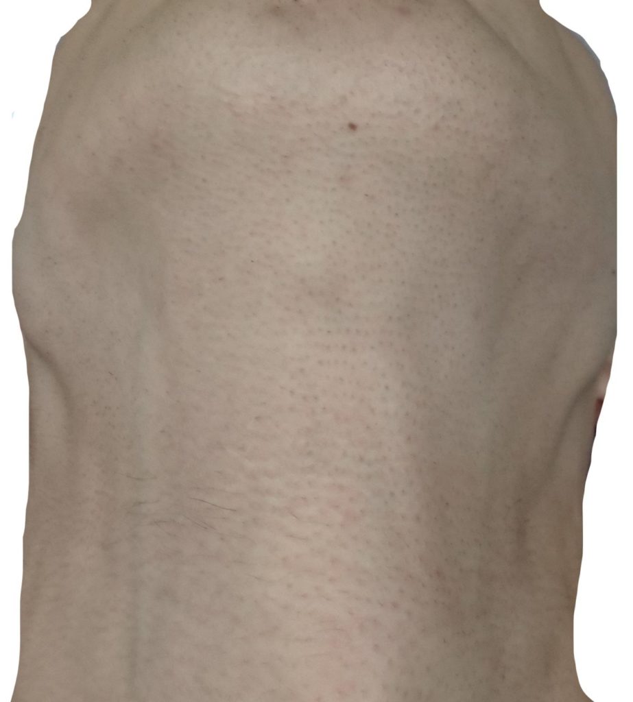 顎下脱毛６回目２４時間後