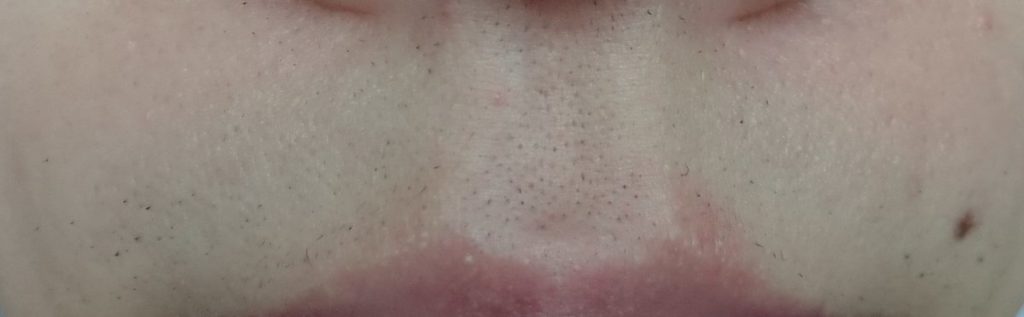 鼻下脱毛６回目２４時間後