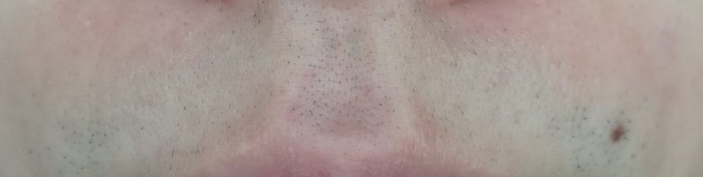 鼻下脱毛６回目直前２４時間後