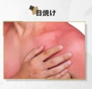 日焼けで施術不可の場合