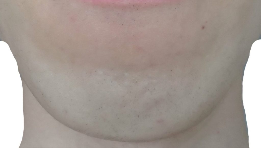 顎脱毛8回目直前24時間後