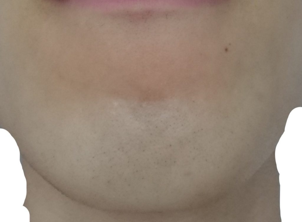 あご脱毛８回目照射後から３週間後