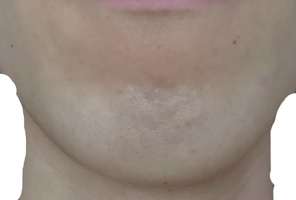 顎脱毛８回目照射後から２週間後の２４時間後