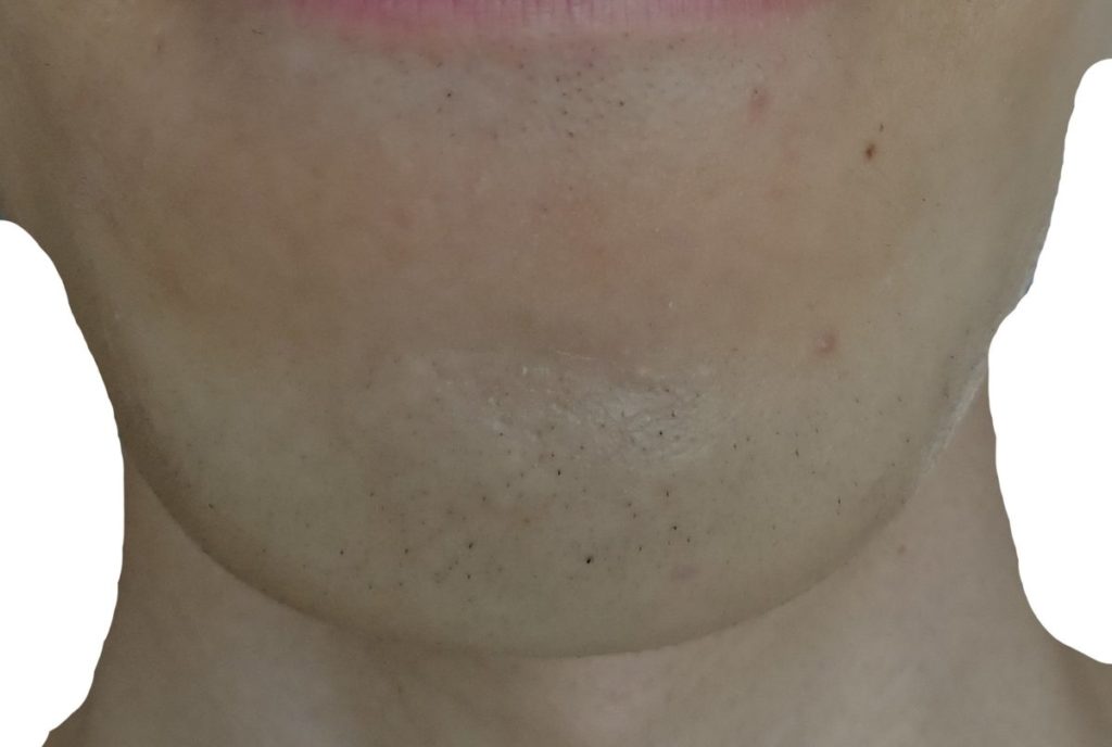 あご脱毛７回目２４時間後