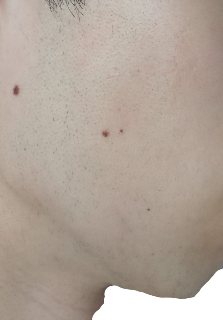 右もみあげ脱毛８回目７２時間後