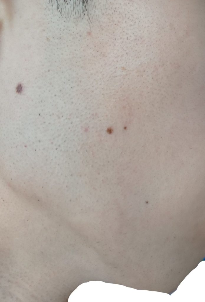 右もみあげ脱毛８回目照射後から２週間後の２４時間後