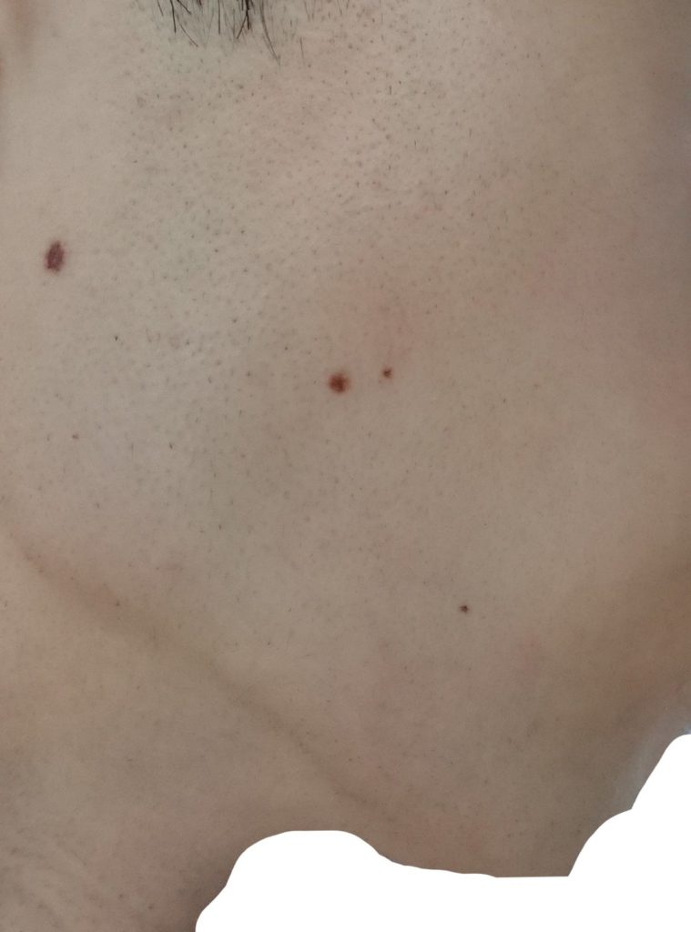 右もみあげ脱毛８回目照射後から３週間後