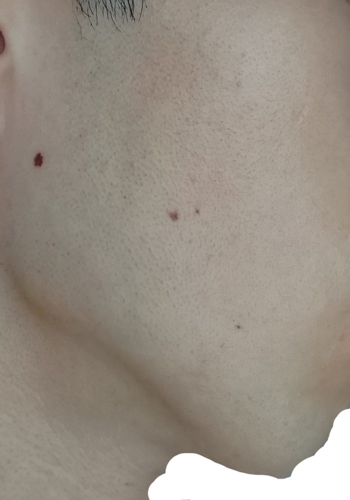 右もみあげ脱毛７回目２４時間後