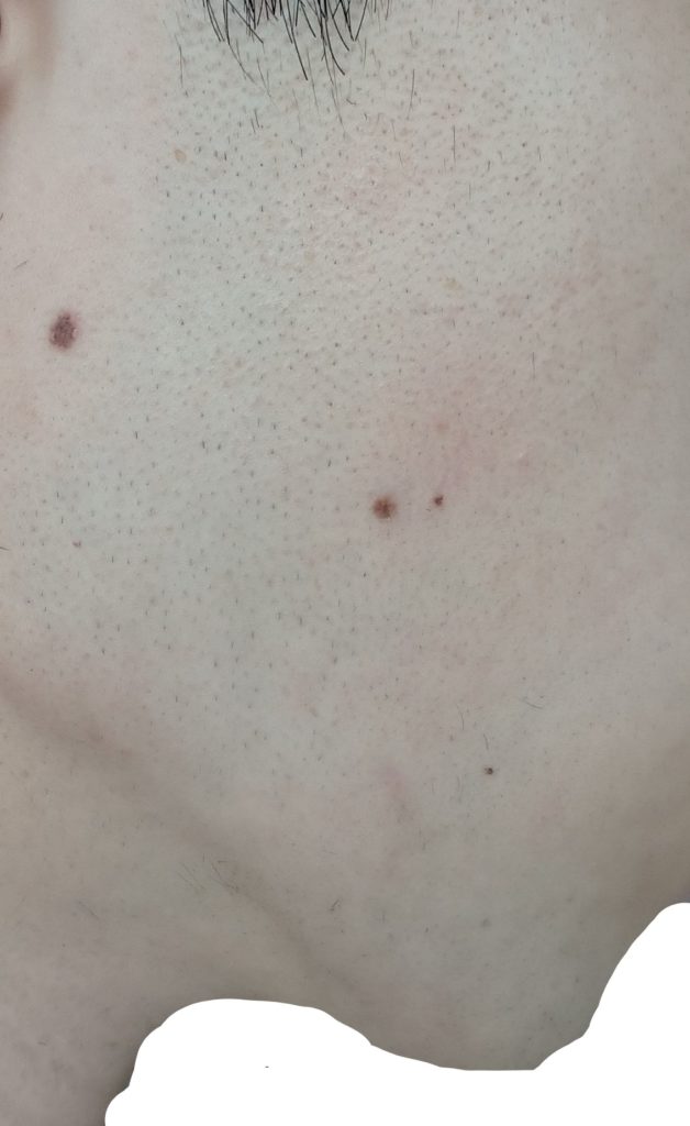 右もみあげ脱毛8回目直前24時間後