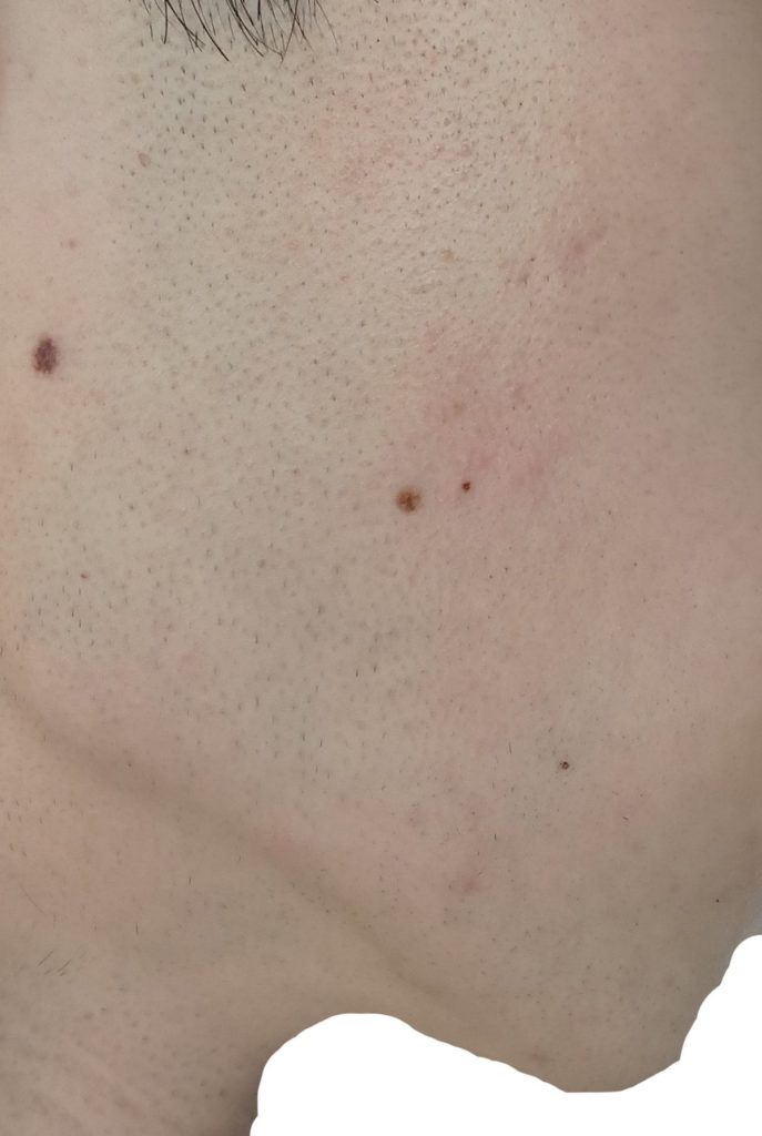 右もみあげ脱毛7回目直前24時間後