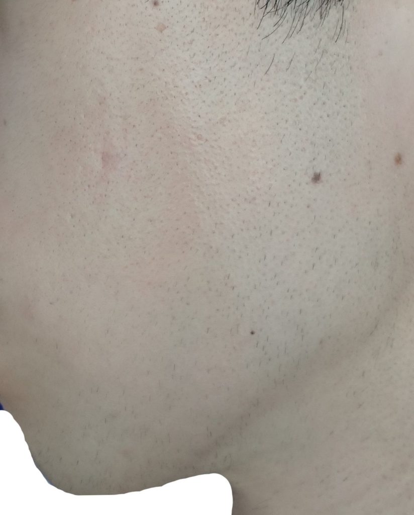 左もみあげ脱毛８回目２４時間後