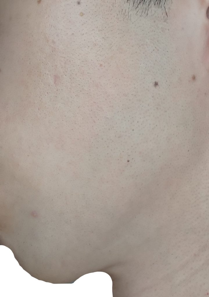 左もみあげ脱毛８回目照射後から２週間後の２４時間後