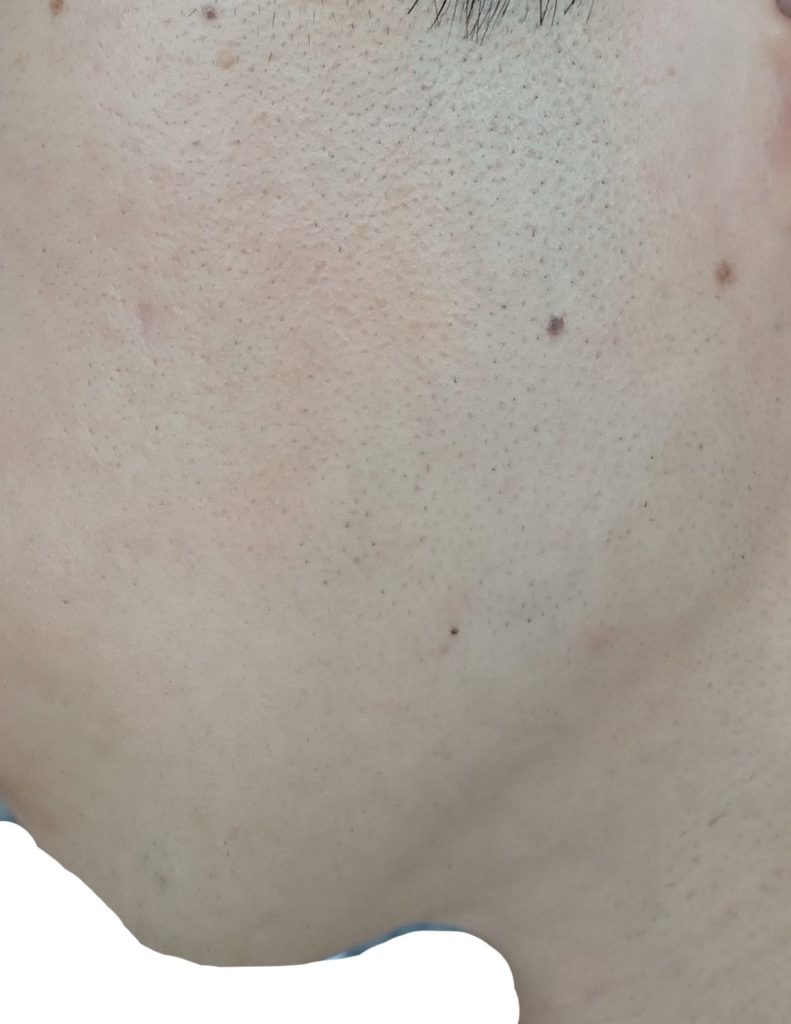 左もみあげ脱毛７回目２４時間後