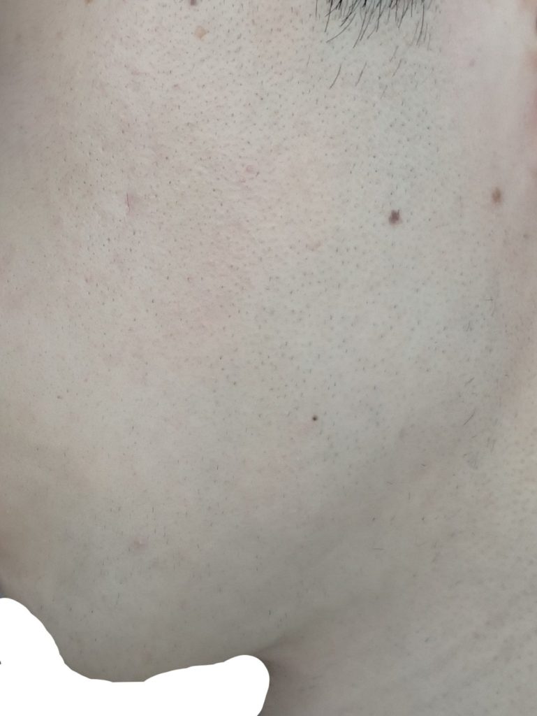 左もみあげ脱毛8回目24時間後