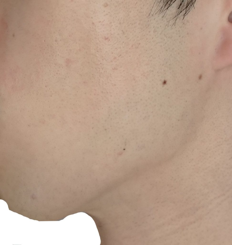 左もみあげ脱毛7回目直前24時間後